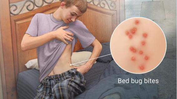 bed bugs