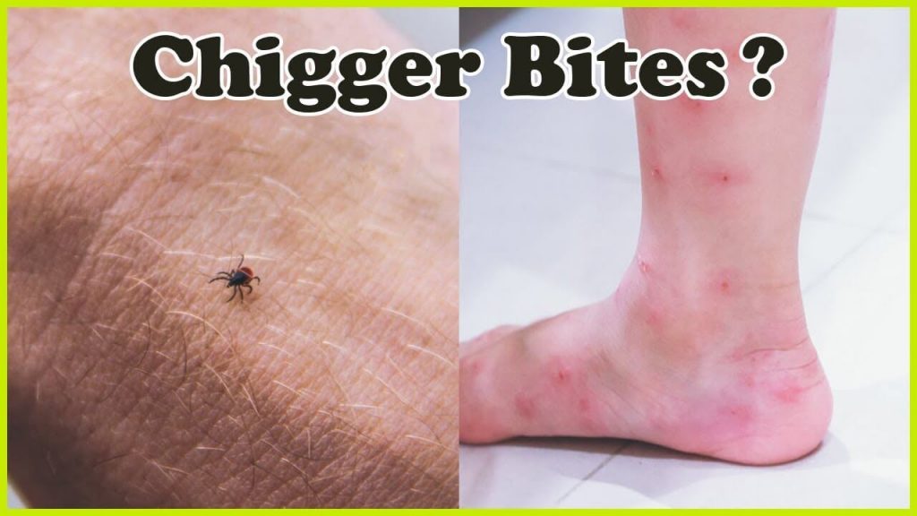 how to get rid of chiggers